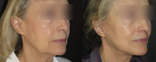 lifting cervico facial