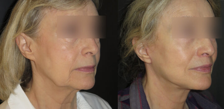 lifting cervico facial