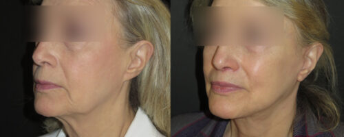 lifting cervico facial