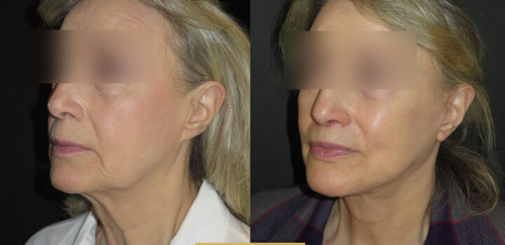 lifting cervico facial