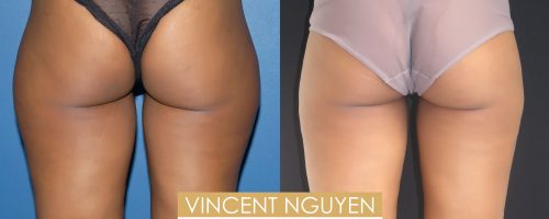 lipoaspiration de la culotte de cheval