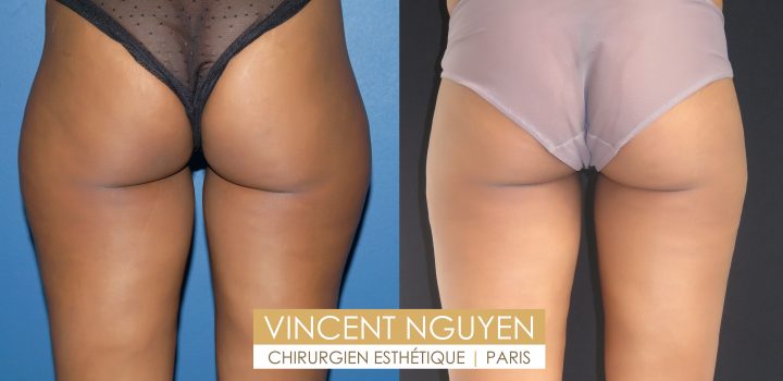 lipoaspiration de la culotte de cheval