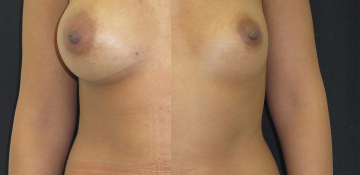 Augmentation mammaire par lipofilling
