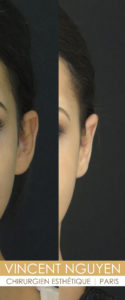 otoplastie