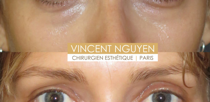 blépharoplastie inférieure