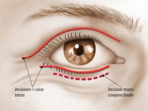 blépharoplastie