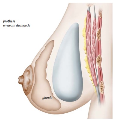 ptose mammaire