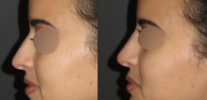 rhinoplastie médicale