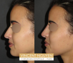 Rhinoplastie médicale