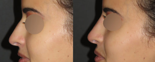 Rhinoplastie médicale