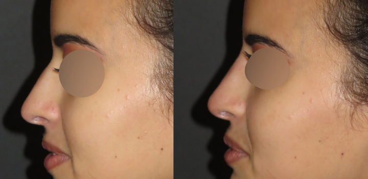 Rhinoplastie médicale