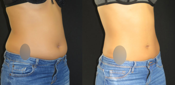 lipoaspiration abdomen et flancs