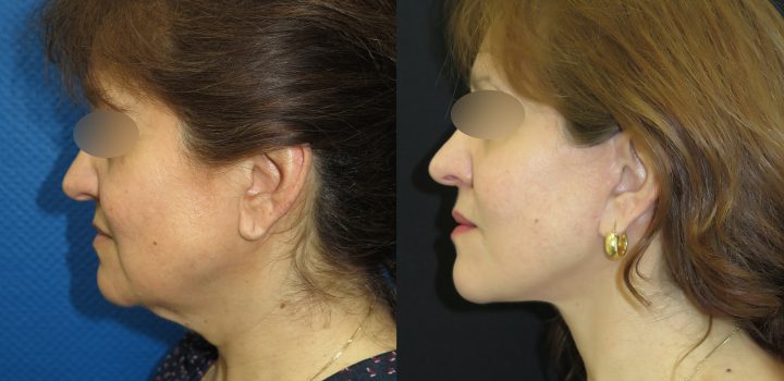 Lifting cervico-Facial