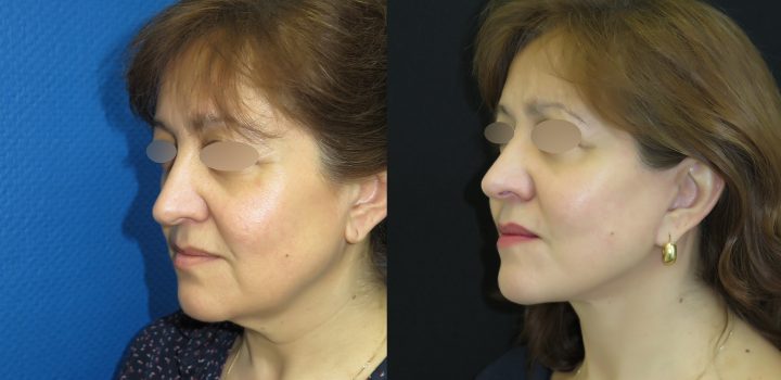 Lifting cervico-Facial