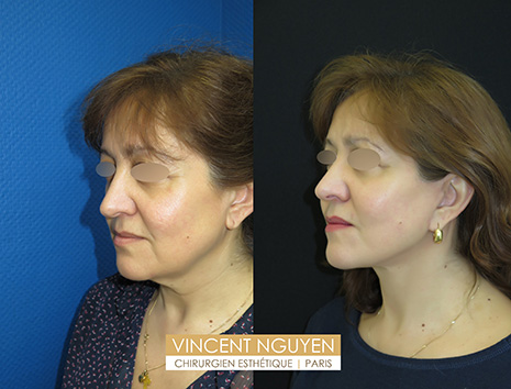 Lifting cervico-Facial